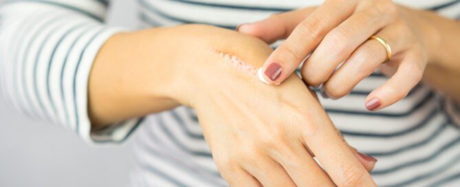 Close up of woman with wound on hand, treating with skin care.